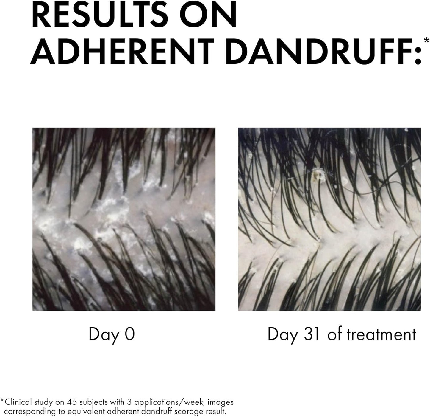 Vichy Dercos Anti-Dandruff Treatment Shampoo 🌿 200ml